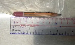 Bé trai nhét bút chì 8 cm vào hậu môn Bé trai nhét bút chì 8 cm vào hậu môn