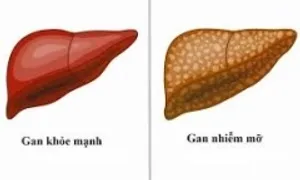 Gan nhiễm mỡ - kẻ giết người thầm lặng Gan nhiễm mỡ - kẻ giết người thầm lặng