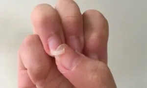 Dấu hiệu móng tay bất thường cảnh báo bệnh Dấu hiệu móng tay bất thường cảnh báo bệnh